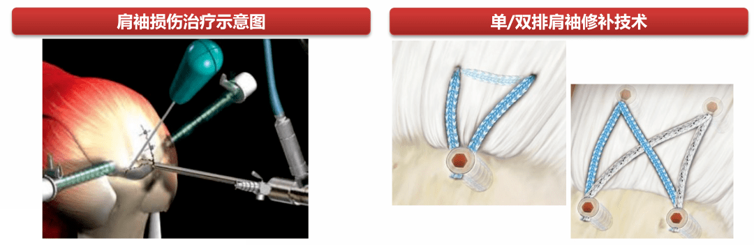 肩袖損傷治療